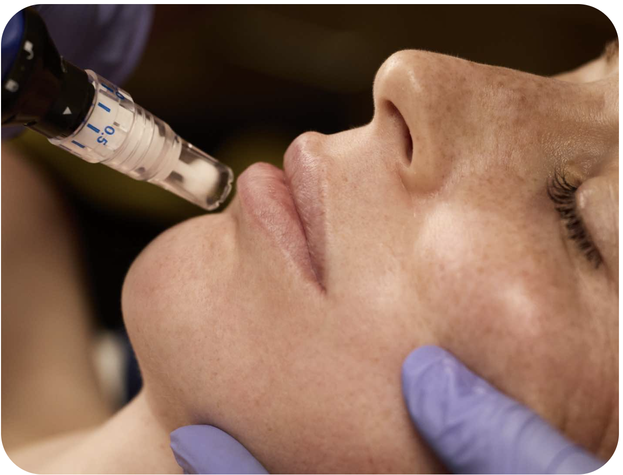 skinpen microneedling at new age medspa in anchorage alaska